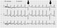 Extrasistole ventricolare: è un battito cardiaco prematuro, ossia un evento elettrico del muscolo cardiaco che avviene prima del previsto, alterando la successione regolare dei battiti nel ritmo sinusale[55]