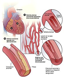 Enfermedad coronaria