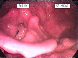 Description de l'image Laryngitis gastrica.jpg.