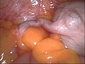 Appendix vermiformis vor einer laparoskopischen Entfernung