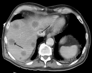 Budd–Chiari syndrome