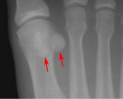 Ayağın birinci metatarsal sümüyünün distal ucunda sesamoid sümüklər.