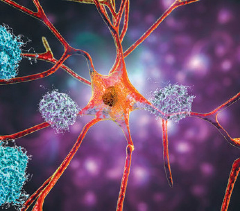 Alzheimer, Foto: Dr_Microbe/stock.adobe.com