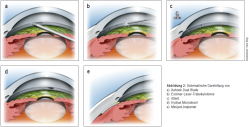 Schematische Darstellung von a) Kahook Dual Blade, b) Excimer-Laser-Trabekulotomie, c) iStent, d) Hydrus Microshunt, e) Miniject-Implantat