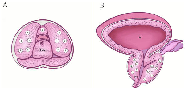 Puncture sites of standard 11 core systematic biopsies.