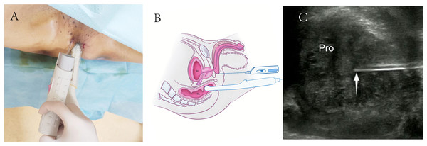 Schematic diagram of transrectal ultrasound guided transperineal prostate biopsy.