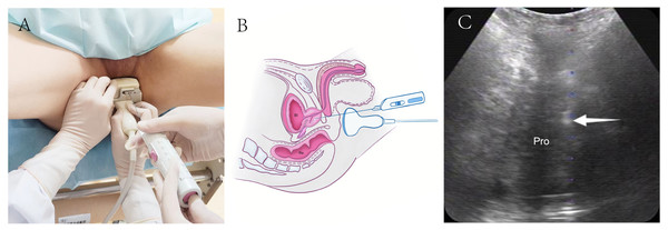 Schematic diagram of transperineal ultrasound guided transperineal prostate biopsy.