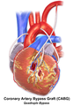 Illustration of Quadruple bypass